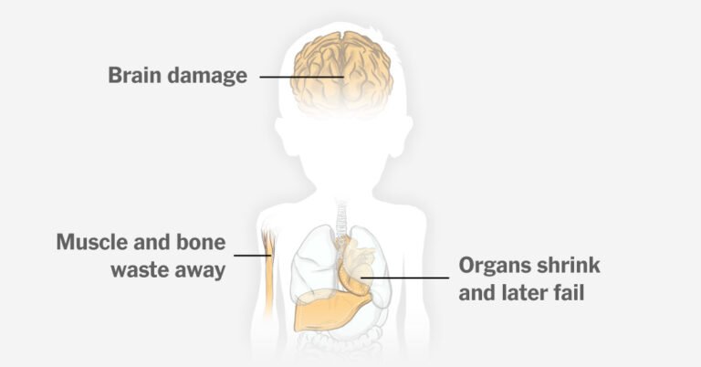 For Gaza’s Children, Acute Malnutrition Could Cause a Lifetime of Health Challenges